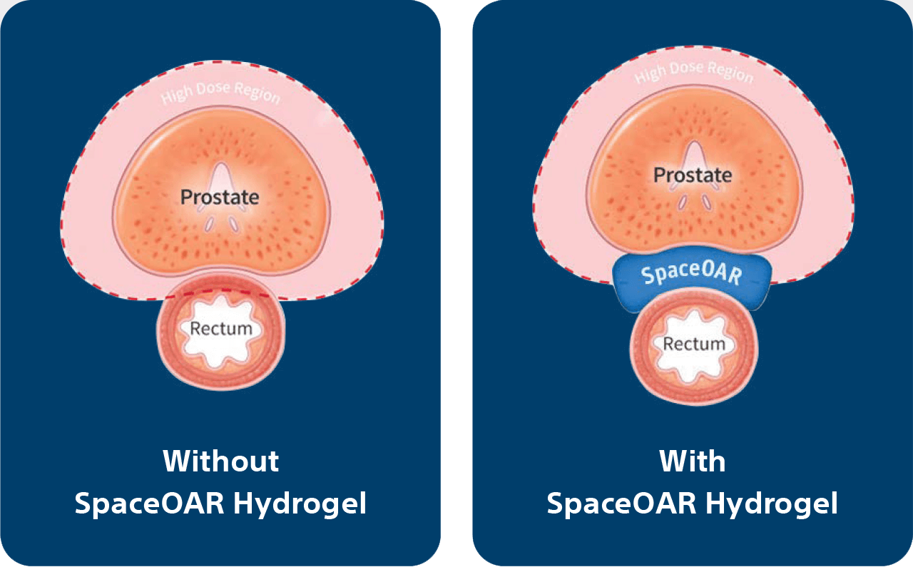 spaceoar-side-by-side-prostate.png