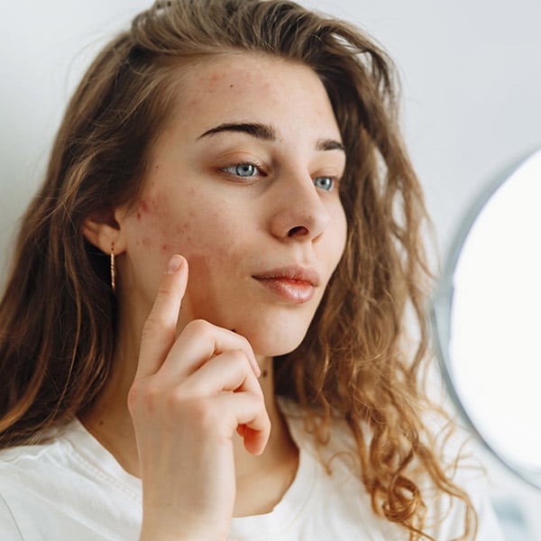 Young Woman With Problem Skin Looking Into Mirror