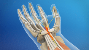 Carpal Tunnel Release